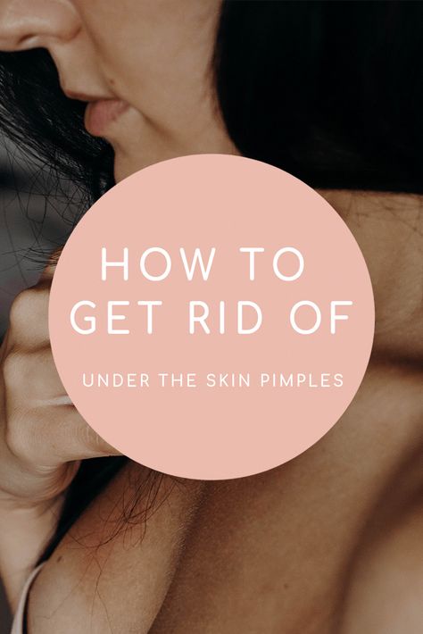 If you've ever dealt with an under the skin pimple, you know what I mean when I say that it's definitely the most painful and obnoxious type of pimple out there. The big question that I know you're probably looking for an answer to is how to get rid of under the skin pimples! We've got you covered--check out this blog! How To Treat Under The Skin Pimples, Under The Skin Pimples, Best Acne Scar Removal, Nose Acne, Painful Acne, Blind Pimple, Acne Redness, Stubborn Acne, Pimples Under The Skin