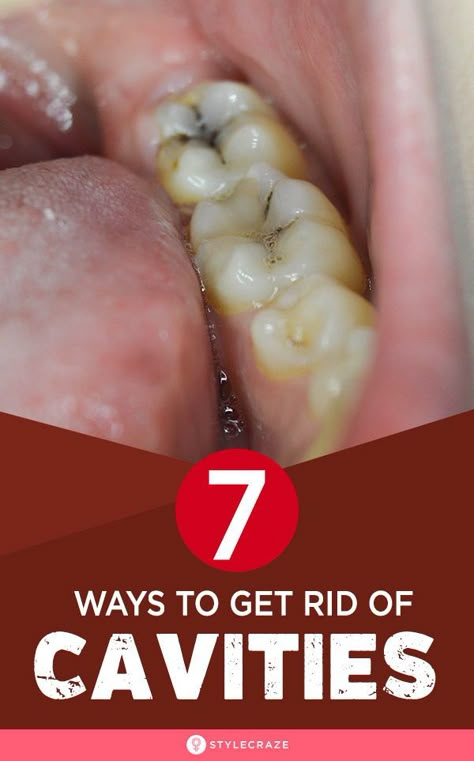 7 Home Remedies To Get Rid Of Cavities: Cavities are one of the most common oral health problems. They are quite common across a wide age group, ranging from children and teenagers to older adults. The following home remedies can help prevent and/or reverse cavities only if the decay hasn’t penetrated the dentin. #Remedies #HomeRemedies Home Remedies For Cavities, शुभ शुक्रवार, Reverse Cavities, Water Food, Natural Healing Remedies, The Teeth, Avocado Smoothie, Diy Remedies, Oral Health Care