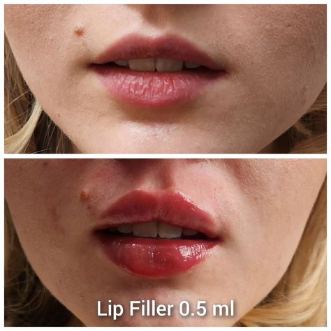 Belle Clinic North West London NW11 8DY Top Lip Filler 1ml by new techniques. Special offer £150 To book in please call on 02089367686 Visit our website for more information www.belleclinic.co.uk Email us Info@belleclinic.co.uk #atabeauty #beautyinessex #beautylondon #beautycareer #lovessex #essexaesthetics #londonaesthetics #lipfillers #ips #fillers #beautyinessex#fillers #botox #lipfillerbeforeandafter #lipinjections #beauty #aesthetics #botox #lipfiller #juvederm #levelseven #lipenha... Filler Aesthetic, Lip Filler No Cupids Bow, Lip Filler Minimal, 1ml Lip Filler, Lip Filler Inspo 0.5ml, .5ml Vs 1ml Lip Filler, Lip Filler Inspiration 0.5ml, Studio Ghibli Poster, Beauty Careers