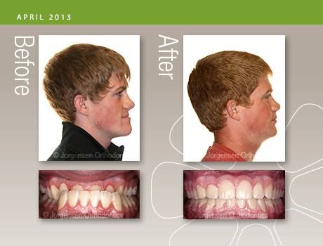 Underbite Before And After, Orthognathic Surgery, Face Transformation, Traditional Braces, Brace Face, Clear Aligners, New Profile, Dental School, Financial Information