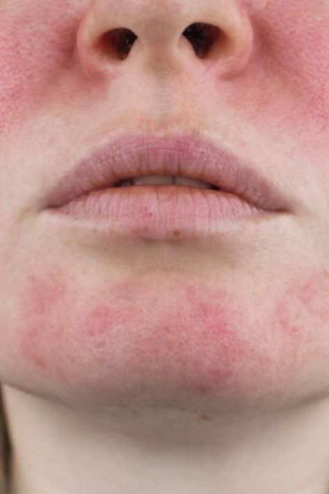 The National Rosacea Society (NRS) has introduced a new Seal of Acceptance program aimed at identifying skin care and cosmetic products that may be suitable for individuals suffering from rosacea. This chronic immune-mediated skin condition affects millions of people worldwide. It is characterized by symptoms such as inflamed bumps, redness, swelling, and visible blood vessels. Now, people who are suffering with flare-ups will have some guidance before adding to cart. Water Blister, Sustained Investigation, Inflamed Skin, Health Chart, A Seal, Healthier Skin, Lack Of Energy, Skin Redness, Skin Condition