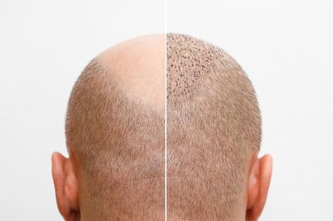 Restore Hair Health, Hair Transplant Women, Before And After Hair, Prp Hair, Hair Transplant Procedure, 3d Graffiti, Photo Hair, Fue Hair Transplant, Hair Transplant Surgery