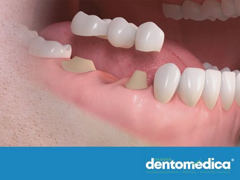 LOS MEJORES IMPLANTES DENTALES EN LEÓN GUANAJUATO. Un puente dental fijo es una prótesis que se apoya sobre los dientes sanos de un paciente y sirve para sustituir uno o varios dientes naturales perdidos, para que la boca se mantenga realizando sus funciones de forma adecuada, así como para que el paciente se sienta cómodo y seguro con su imagen. En DENTOMÉDICA te invitamos a agendar una cita llamando al teléfono (477)5142828. #sonrisaperfectaconprótesisdentalesenleónguanajuato Lokai Bracelet, Live Lokai Bracelet, Convenience Store Products, Guanajuato