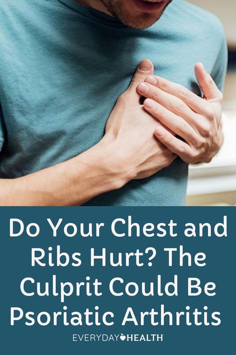 Psoriatic arthritis can sometimes lead to chest or rib pain. Blame costochondritis, an inflammation of the cartilage connecting the ribs and the breastbone. Rib Pain, Ra Symptoms, Ic Diet, Joints Pain Remedy, Arthritic Pain, Pain Relief Remedies, Ligaments And Tendons, Chronic Pain Relief, Auto Immune