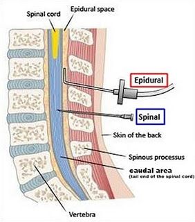 Accidental Total Spinal Anesthesia Spinal Anesthesia, Anesthesia School, Crna School, Nurse Anesthesia, Intravenous Fluids, Radiology Technologist, Medical School Motivation, Nursing School Notes, Medical School Essentials