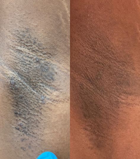 We are now offering intimate bleaching services for underams, Brazilian, inner thighs and anus. See results within just one session. This is a safe procedure with complimentary aftercare included. • 👇🏾Book your bleaching service today • WWW.Annsbodybar.com (@annsbodybar) 📍Towson/Baltimore • • • 🤍 🤍 • • Click the link in my bio to secure your spot 🤍 •​​​​​​​​​​​​​​​​​​​​​​ #baltimorewaxing #baltimorewaxer #towsonwaxer #towson #dmvwaxing #towsonwaxing #marylandwaxer #dmvwaxer #dmvesthetic... Intimate Bleaching, Inner Thigh, Baltimore, Click The Link, Quick Saves