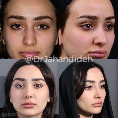 Nose Job In Turkey, Nose Job For Round Face, Nose For Round Face, Side Profile Before And After, Ideal Nose Rhinoplasty, Wide Nose Rhinoplasty, Nose Job Before And After, Nose Inspiration, Revision Rhinoplasty