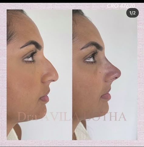 Nose Operation, Bad Nose Jobs, Nubian Nose, Nose Profile, Jaw Reduction Surgery, Nose Surgery Rhinoplasty, V Line Surgery, Nose Fillers, Plastic Surgery Fail