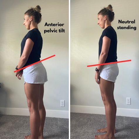 Anterior-pelvic-tilt-front-of-hip-pain Lumbar Lordosis, Anterior Pelvic Tilt, Hip Pain Relief, Pelvic Tilt, Effective Workout Routines, Relieve Back Pain, Pelvic Pain, Hip Pain, Hip Workout