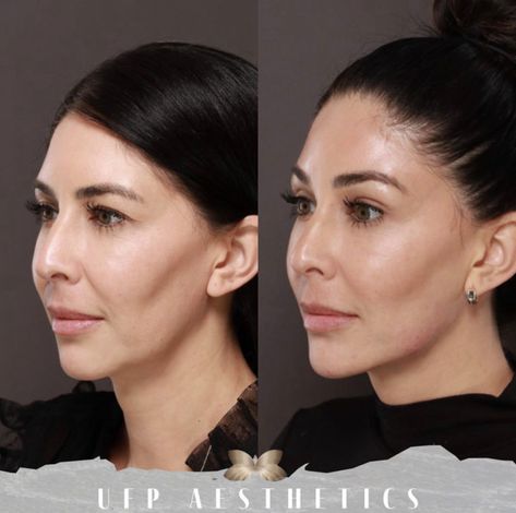 Can Dermal Fillers Get Rid Of My Jowls Pre Jowl Sulcus Filler, Check Filler Before And After, Filler For Jowls, Face Balancing Fillers, Chin Fillers Before After, Face Injections, Chin Filler, Cosmetic Fillers, Face Fillers