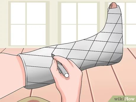 4 Ways to Have Fun With a Broken Leg - wikiHow Cast Designs Leg, Cast Ideas Leg, Cast Decorating Ideas Leg, Leg Cast Decorating Ideas, Crutch Decorations, Broken Ankle Cast, Broken Leg Cast, Ankle Cast, Cast Decoration