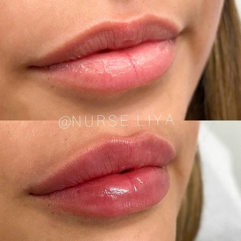 1ml Juvederm Lips, Lip Filler 2 Syringe, Hyaluronic Lip Fillers, Natural Lips Filler, Full Syringe Lip Filler, Natural Looking Lip Injections, Lip Injections Inspiration, Full Syringe Lip Filler Before And After, Lip Fillers Natural Look