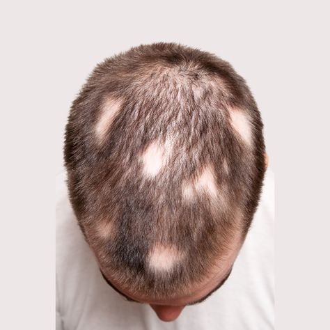 ❓ Can a person with alopecia get a hair transplant? The answer is more complex than a simple yes or no. Let’s break it down: 1. Androgenetic Alopecia (Pattern Baldness): Yes, this is the most common form of hair loss, and a hair transplant is often an effective solution. Research shows that hair transplants in patients with androgenetic alopecia have high success rates. 2. Alopecia Areata (Autoimmune Alopecia): This type is unpredictable. Hair transplants may not be ideal because the immune... Scarring Alopecia, Alopecia Universalis, Androgenetic Alopecia, Pattern Baldness, Hair Restoration, Hair Transplant, Yes Or No, Hair Follicle, Let It Be