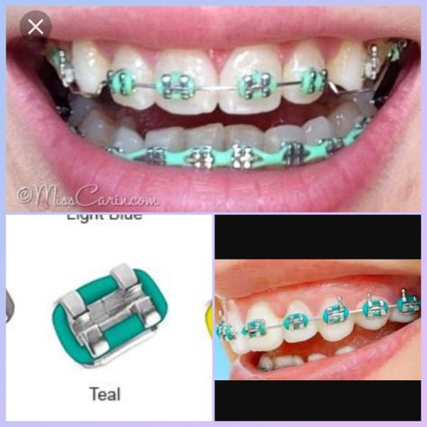 AHHH!! Guys which color? Teal or mint green? Plz let me know in the comments ASAP!!!! Green Braces Color, Mint Braces, Mint Green Braces, Teal Braces, Light Blue Braces, Braces Humor, Green Braces, Dental Braces Colors, Braces Cost