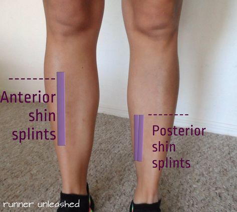 Don’t let Shin Splints get in the way. – Empire Unleashed Shin Splint Exercises, K Tape, Running Injuries, Shin Splints, Athletic Training, Sports Medicine, Running Tips, Roller Derby, Marathon Training