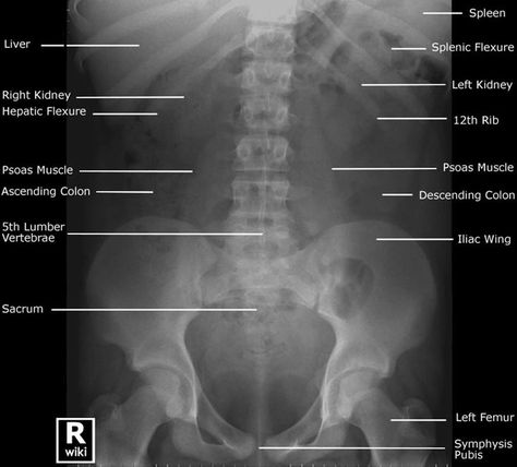 KUB Radiographic Anatomy, Radiology Schools, Medical Radiography, Radiology Humor, Radiologic Technology, Radiology Student, Radiology Imaging, Dental Jokes, Radiology Technologist