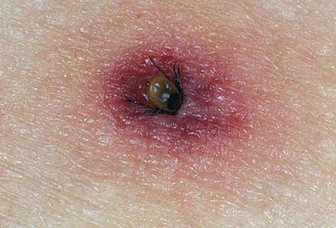 Tick burrowing into human skin......know your bug bites so you can treat properly Bad Bugs, Deer Ticks, Tick Removal, Tick Bite, Bed Bug Bites, Tick Repellent, Spider Bites, Mosquito Bite, Bug Bites