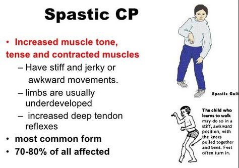 What is Spastic Diplegia Cerebral Palsy? More Cerebral Paralysis, Pediatric Nurse Practitioner, Physical Therapy Assistant, Cord Blood Banking, Pediatric Physical Therapy, Nursing School Studying, School Information, Nursing Notes, Pediatric Nursing