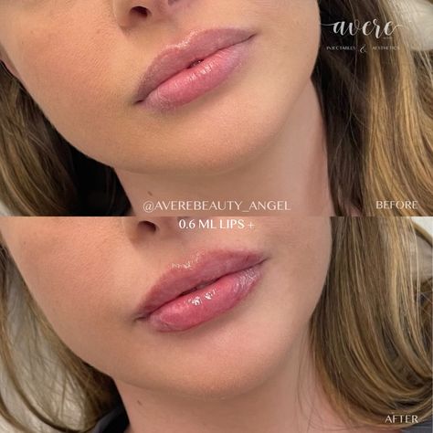 0.55ml Lip Filler, Simple Lip Fillers, Soft Lip Filler, .5ml Vs 1ml Lip Filler, Lips Before And After, 0.5 Lip Filler, 0 5 Ml Lip Filler, Lip Filler 0.5ml, Natural Lip Fillers Before And After