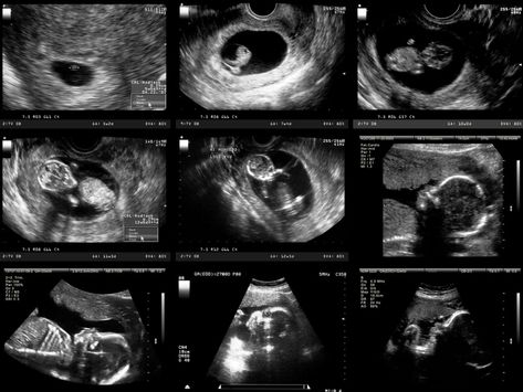 A new, high-tech MRI scan captures amazing video footage of an unborn baby having a dance party inside the womb. First Month Of Pregnancy, Pregnancy Ultrasound, Pregnancy Calculator, Baby Ultrasound, Pregnancy Progression, Ultrasound Pictures, Baby Scan, Fetal Development, Law And Justice