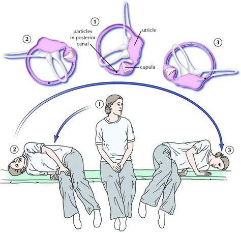 benign-paroxysmal-positional-vertigo-epley-maneuver Ringing Ears Remedy, Epley Maneuver, Vertigo Exercises, Vertigo Relief, Vertigo Remedies, Diagram Design, Medical Terms, Chronic Fatigue, Physical Therapy