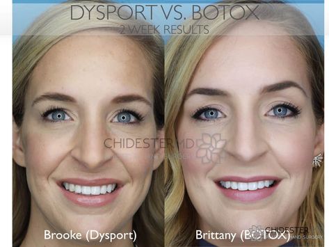 Botox vs. Dysport: An experiment on identical twins - Twin Tested Botox Placement Chart, Dysport Vs Botox Units, Dysport Before And After, Botox Vs Dysport, White Eyeliner Pencil, Muscles Of The Face, Results Day, Candace Cameron, Botox Injections