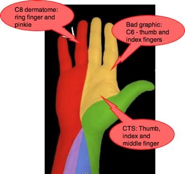 C8 dermatome: Ok, this all started after I got whiplash from my trunk crashing down on my head. Now I have tingling and numbness in my left hand (pinky and ring finger) Tingling In Fingers, Numbness In Fingers, Tingling Hands, Numbness In Hands, Massage Quotes, Anatomy Bones, Ultrasound Tech, Neck Exercises, Working Mom Tips