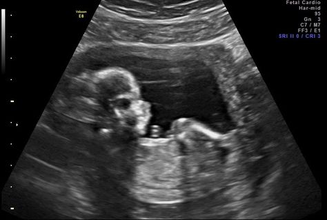 shardonnay summerhays: Boy or Girl? | 20 Week Ultrasound 5 Months Pregnant Ultrasound, 20 Week Ultrasound Pictures, 20 Weeks Pregnant Ultrasound, 22 Week Ultrasound, Ultrasound Boy Or Girl, Boy Ultrasound Pictures, Ultrasound Prank, Ultrasound Gender Prediction, Boy Ultrasound