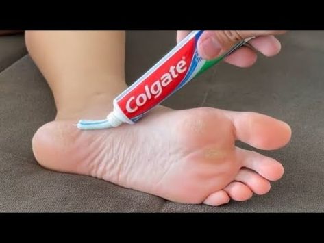 Put TOOTHPASTE on Your FEET - You Won't Believe the Results the Next Day! - USEFUL HOME TIPS - YouTube Clove Toothpaste Diy, Baking Soda Toothpaste Diy, Diy Toothpaste Without Coconut Oil, Homemade Toothpaste With Coconut Oil, Cracked Feet Remedies, Uses For Toothpaste, Cocoa Oil, Dry Cracked Heels, Tooth Decay Remedies Heal Cavities Homemade Toothpaste