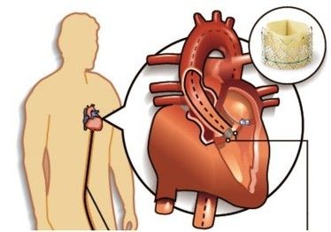 Transcatheter aortic valve implantation (TAVI), also referred as transcatheter aortic valve replacement, or percutaneous valve replacement is a minimally invasive procedure that repairs the functionality of the old and damaged valve. Aortic Valve Replacement, Heart Valve, Heart Valves, Primary Research, Industry Analysis, Secondary Source, Corporate Presentation, American Heart Association, Research Report