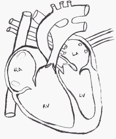 Patent Ductus Arteriosus via GIPHY Patent Ductus Arteriosus, Nurse Educator, Ultrasound Technician, Congenital Heart Defect, Heart Defect, Congenital Heart, Nursing Education, Ultrasound, Gif