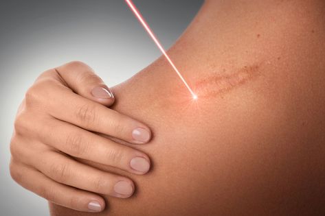 Burn Scar Removal, Laser Stretch Mark Removal, Laser Scar Removal, Tattoo Removal Cost, Hypertrophic Scars, Scar Reduction, Laser Skin Resurfacing, Stretch Mark Removal, Severe Acne