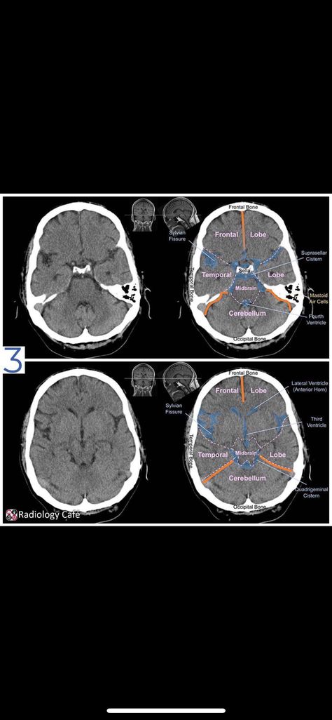 Ct Brain, Brain Mri, Medical Radiography, Brain Problems, Radiology Technician, Radiology Imaging, Brain System, Medical Quotes, Radiology Technologist