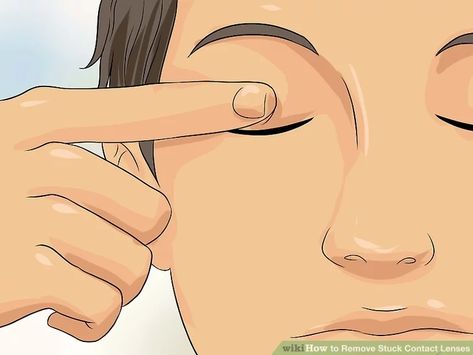 3 Ways to Remove Stuck Contact Lenses - wikiHow Removing Contact Lenses, Contact Lenses Tips, Eye Tricks, Eye Contact Lenses, Soft Contact Lenses, Sore Eyes, Dry Eyes, Eye Contact, Contact Lenses