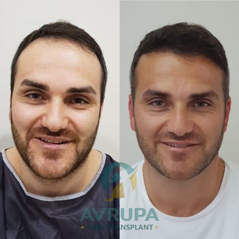 A patient with a receding hairline received 4500 grafts transplant to reduce the size of his forehead and restore the temples. Swipe left for more photos

#hairtransplant #hairtransplantturkey #hairtransplantistanbul #transplantedecabelo #trapiantodicapelliinturchia #greffedecheveux #greffedecheveuxturquie #foreheadreductionbeforeandafter #transplantecapilar #hairtransformtion #hairtransplantresults #hairtransplantbeforeandafter #hairloss #baldness #hair Forehead Reduction, Hair Transplant Results, Receding Hairline, Hair Transplant, More Photos, Hair, Quick Saves