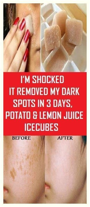 I’m SHOCKED It Removed My Dark Spots In 3 Days, Magic Remedy Dark Spots On Legs, Potato Juice, Onion Juice, Brown Spots On Face, Spots On Face, Acne Spots, Pomegranate Juice, Homemade Face, Gain Weight