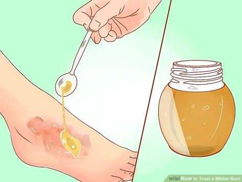 3 Ways to Treat a Blister Burn - wikiHow How To Treat Blisters, Skin Blisters, Treat Burns, Wounded Healer, Degree Burns, Severe Burns, Honey Benefits, Health Guide, Layers Of Skin