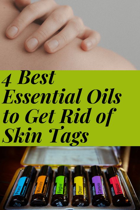 Oils For Skin Tags, Causes Of Skin Tags, Skin Tags Essential Oils, What Are Skin Tags, Best Essential Oils For Skin, Remove Skin Tags Naturally, Oregano Essential Oil, Skin Moles, Skin Tags