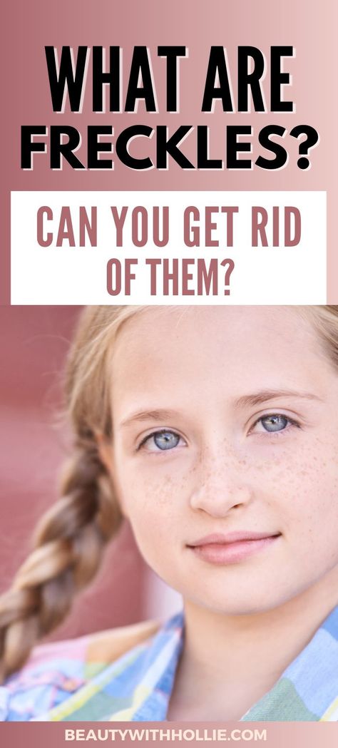 What are freckles and can you get rid of them? How To Get Rid Of Freckles On Face, How To Remove Freckles From Face, Remove Freckles From Face, How To Get Rid Of Freckles, Getting Rid Of Freckles, Freckle Juice, Get Rid Of Spots, Freckle Remover, Red Freckles