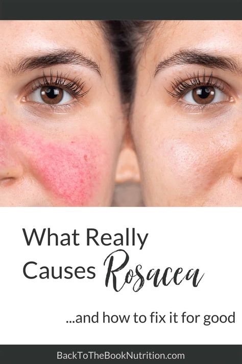 How To Stop Redness On Face Skin Care, Skin Care Reduce Redness, How To Help Redness On Face, How To Fix Redness On Face, Facial Redness Remedies, Get Rid Of Redness On Face, Rosatia Remedies, Face Redness Remedy, Roscea Help