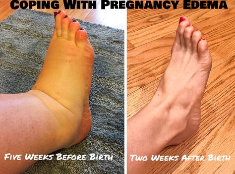 Pregnancy Shoes Comfortable, Postpartum Swelling, Swollen Feet Pregnancy, Swollen Feet Remedies, Swelling Remedies, Pregnancy Swelling, Pregnancy Remedies, Postpartum Care Kit, Pregnancy Pain