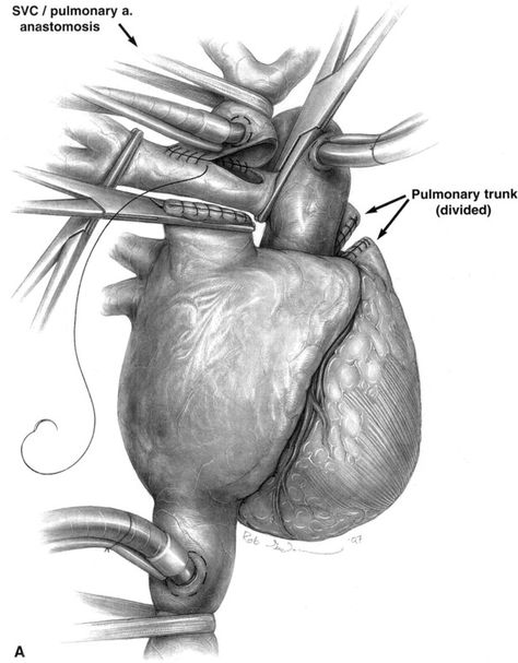 Extracardiac Lateral Tunnel Modification of the Fontan Procedure - Operative Techniques in Cardiac and Thoracic Surgery Superior Vena Cava, Central Venous Pressure, Thoracic Surgery, Prothrombin Time, The Conduit, Medical Illustration, Cardiology, Blood Flow, Surgery