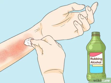 Apple Cider Vinegar For Poison Ivy, Remedy For Poison Ivy Rash, Poison Ivy Bath Soak, How To Stop Poison Ivy Itching, Essential Oils For Poison Oak, How To Treat Poison Ivy, Stop Poison Ivy Itch, How To Get Rid Of Poison Oak, Natural Poison Ivy Remedy