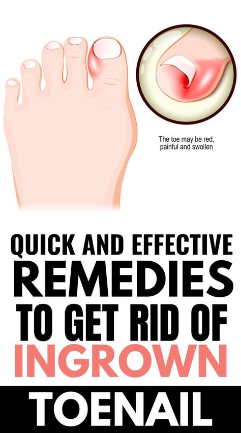 Toenail Pain, Infected Toenail, Toenail Fungal Infection, Nail Remedies, Nail Infection, Nail Fungus Remedy, Ingrown Toenail, Ingrown Nail, Fungal Nail