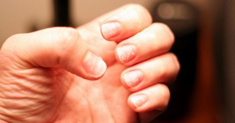 Healthy Fingernails, White Spots On Nails, Nail Ridges, Nails After Acrylics, Remove Acrylic Nails, Nail Problems, Nail Infection, Weak Nails, Nail Repair