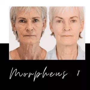 Morpheus 8 Before And After, Morpheus 8, Elite Aesthetics, Face Treatments, Anti Wrinkle Injections, Tear Trough, Cheek Fillers, Dermal Fillers, Lip Fillers