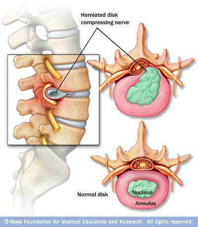 Disk Herniation, Bulging Disc, Spinal Nerve, Chiropractic Adjustment, Back Pain Remedies, Spine Health, Spine Surgery, Upper Back Pain, Sciatica Pain