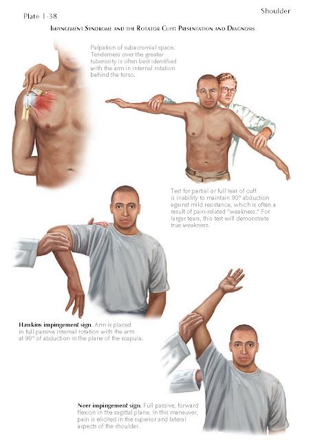 Impingement Syndrome And The Rotator Cuff Rotator Cuff Tendinosis, Shoulder Rehab Exercises, Shoulder Anatomy, Rotator Cuff Tear, Shoulder Impingement, Rotator Cuff Injury, Shoulder Pain Relief, Human Body Anatomy, Reflexology Massage