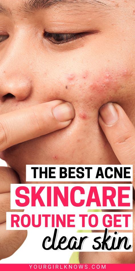 Teenage Acne Skincare Routine, Best Skin Care For Acne, Best Cerave Products, Acne Skincare Products, Cerave Products, Cystic Acne Remedies, Products For Acne, Teenage Acne, Forehead Acne