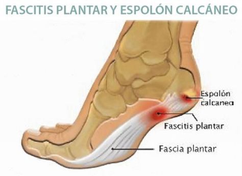 Fascitis Plantar [Síntomas, Tratamiento y Ejercicios] | PadelStar Facitis Plantar, Sensory Nerves, Foot Spa, Best Walking Shoes, Heel Pain, Best Running Shoes, Foot Pain, Pie, Heels